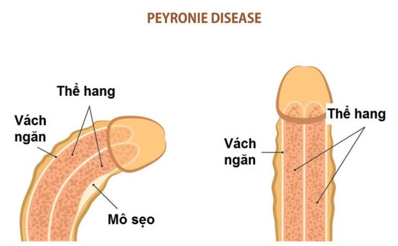 Đường cong tốt hơn hoặc bước 4